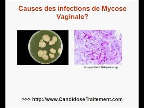 mycose vaginale perte|Mycose vaginale : symptômes, diagnostic et。